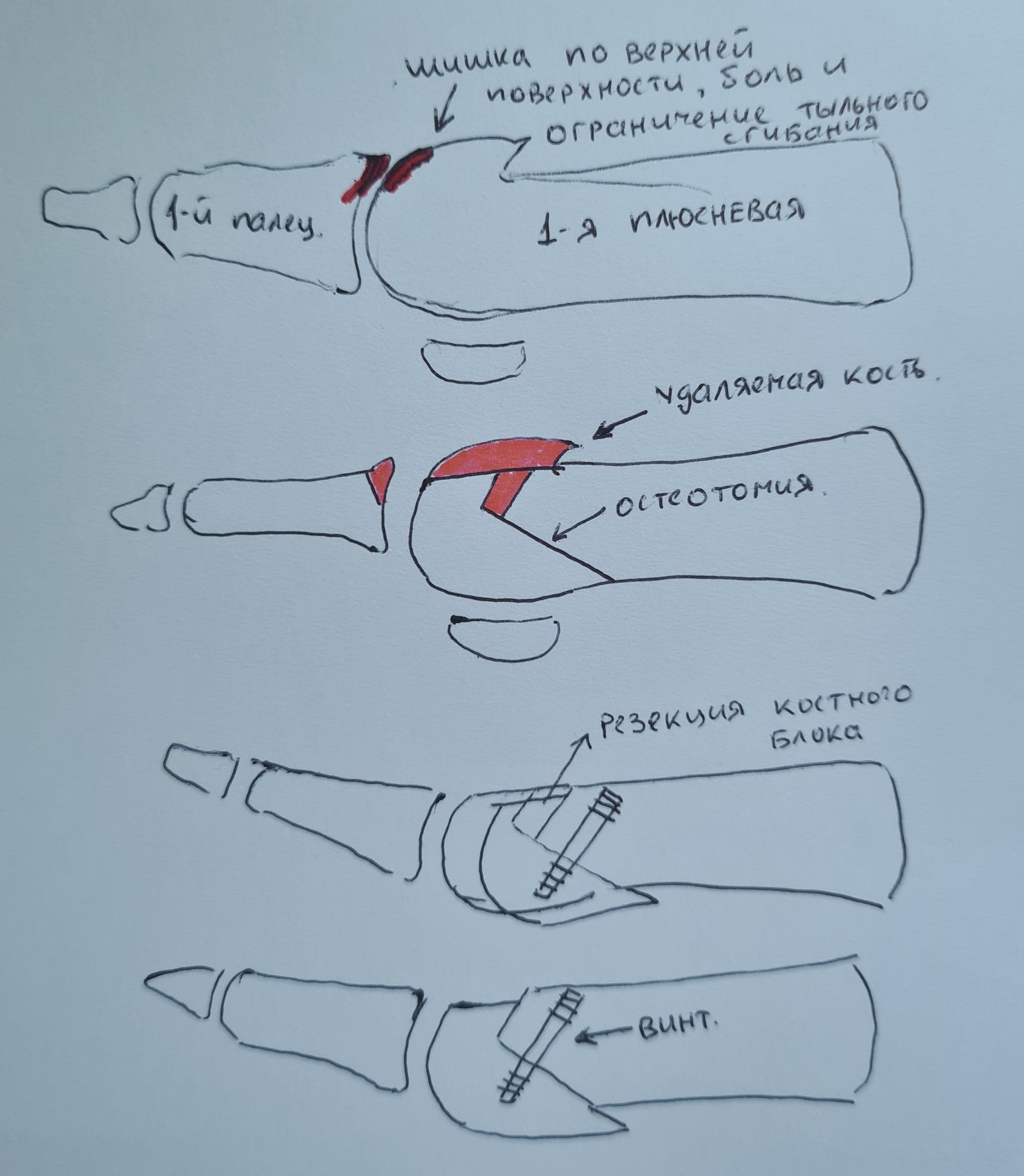 Операции при халлюкс ригидус (Hallux rigidus)